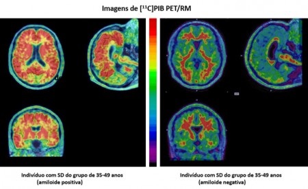 Técnica de medicina nuclear é usada para estudar a doença de Alzheimer em pessoas com síndrome de Down